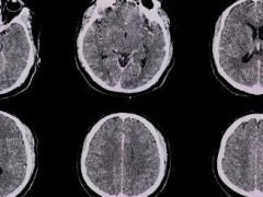 男子切生猪肉时割伤手指险丧命 警惕猪链球菌感染