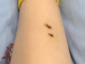 女子被蛇咬伤两年仍有后遗症