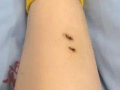 女子被蛇咬伤两年仍有后遗症 康复之路漫长艰难