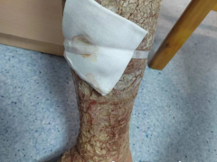 男子腿痒没在意 变成“树皮腿” 干燥性湿疹继发丹毒