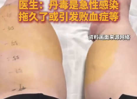 男子抠脚不洗手右腿肿成猪蹄 200斤男子爱抠脚染上丹毒