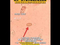 医生淘洗粪便3小时找到肝吸虫 微小虫卵大海捞针